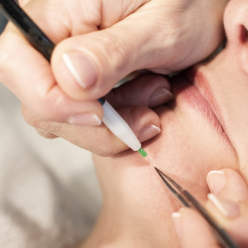 Elektrische epilatie