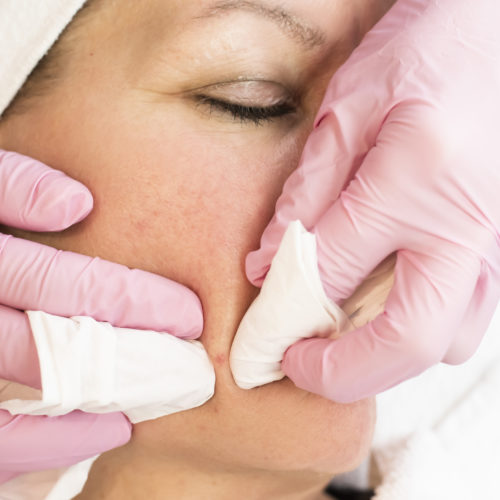 Acne en acne-littekens