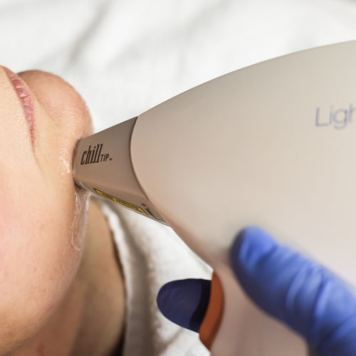 Laser/IPL ontharen gezicht