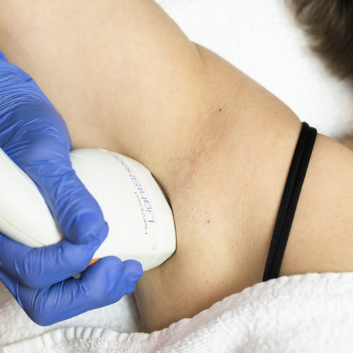 Laser/IPL ontharen lichaam