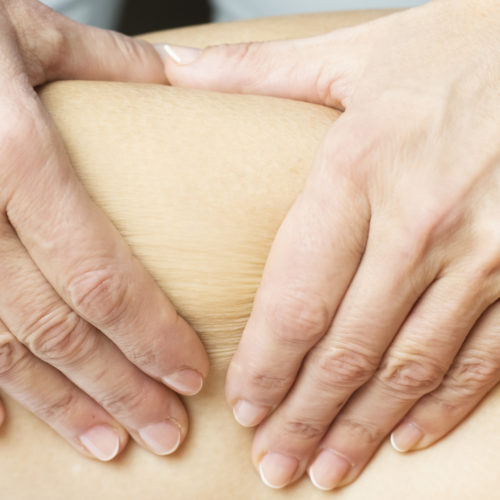 Cellulitis