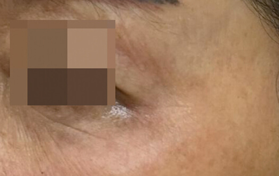 Mesoéclat Anti-Aging Behandeling - After treatment