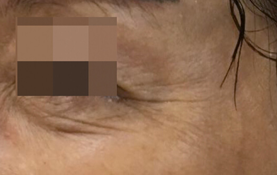 Mesoéclat Anti-Aging Behandeling - Before treatment